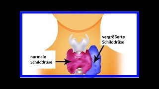 Hyperthyreose bei Frauen Symptome und empfohlene Nahrungsmittel [upl. by Ramsay]