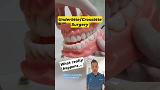 From Underbite to Aligned Bite Underbite Jaw Surgery Explained shorts dentallan dentist [upl. by Kessel]