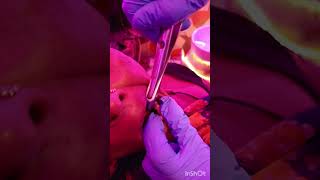 Root canal treated tooth extraction [upl. by Kiri449]