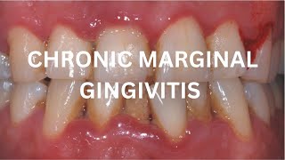 Chronic Marginal Gingivitis amp Aggressive Periodontitis [upl. by Adihsar171]