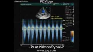 echocardiogram of severe pulmonary stenosis [upl. by Bollay]