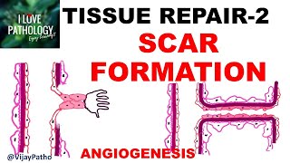 TISSUR REPAIR Part 2 Repair by SCAR formation ANGIOGENESIS GRANULATION TISSUE TISSUE REMODELING [upl. by Arahs705]