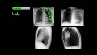 Lobar Atelectasis on Frontal and Lateral Chest XRays UndergroundMed [upl. by Ilak]