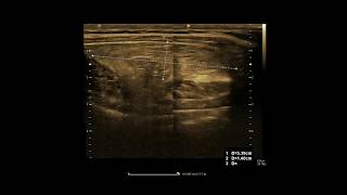 Lipoma  Ultrasound  Case 15 [upl. by Lukin]