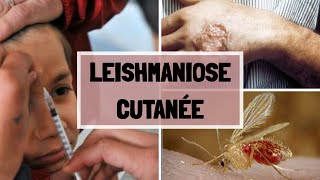 LA LEISHMANIOSE CUTANNÉ  CAUSES  SYPMTOMES  COMPLICATIONS  TRAITEMENT [upl. by Navoj]