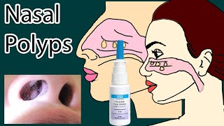 Nasal Polyps symptoms causes and treatment [upl. by Anhsirk775]