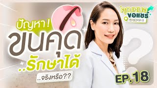 คุณหมอขอแชร์  EP18 ปัญหาขนคุด รักษาได้จริงหรือ [upl. by Taima603]