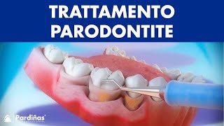 Trattamento parodontite – Curettage e sondaggio parodontale © [upl. by Bodwell206]