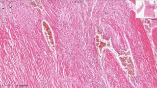 Myocardial Infarction  Histopathology [upl. by Haze]