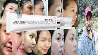 la roche posay redermic r retinol cream  honest review [upl. by Atilrep559]