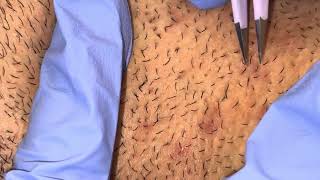 Ingrown Hairs Plucked from Beard [upl. by Cran]