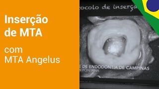 MTA Angelus  Protocolo de inserção do MTA [upl. by Teerpnam]