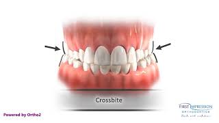 Correcting Posterior Crossbites [upl. by Galligan]