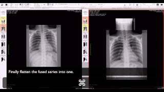 OsiriX  manual fusion of two series [upl. by Aimal]