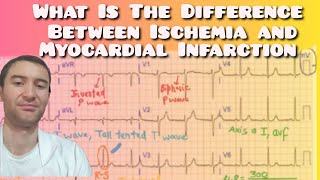 Myocardial Infarction vs Ischemia Whats the Difference [upl. by Alcus]