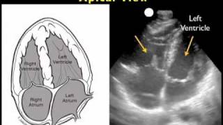 How to Cardiac Ultrasound  Apical View Case Study [upl. by Htebaras]