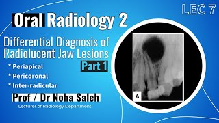 Oral Radiology 2  Lec 7  Differential Diagnosis of Radiolucent Jaw Lesions  Part 1 [upl. by Torrey]