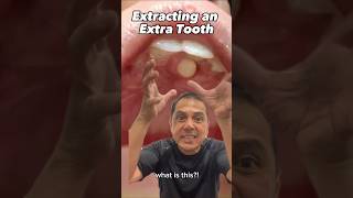 Supernumerary Tooth amp Mediodens Extraction EXPLAINED In Office to Hands On Dental Training shorts [upl. by Hoashis451]