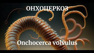 ОНХОЦЕРКОЗ Onchocerca volvulus МЕДИЦИНСКАЯ ПАРАЗИТОЛОГИЯ  Морфология Симптомы Диагностика Цикл [upl. by Atinad]