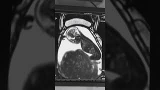 Fetal MRI  Siemens [upl. by Nelly446]