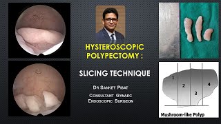 Hysteroscopic Polypectomy Slicing Technique  Polyp removal surgery [upl. by Ynohtnael358]