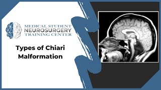 Types of Chiari Malformation [upl. by Nenney]