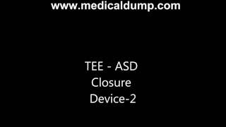 Atrial Septal Defect Closure Device  TransEsophageal Echocardiography TEE [upl. by Kilroy]