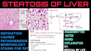 Steatosis Of Liver  Fatty Liver  Pathology [upl. by Ailadgim]