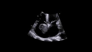 Primary Cardiac Synovial Sarcoma [upl. by Mikiso]