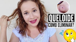 COMO ELIMINAR QUELOIDE DO PIERCING  DUAS DICAS  POR LEYA ARAGÃO [upl. by Brynna]