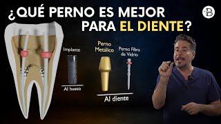 PERNO METÁLICO vs PERNO DE FIBRA DE VIDRIO ¿Cuál es la mejor opción para tu sonrisa [upl. by Elleoj]