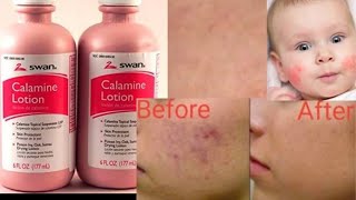 Calamine Lotion 🥰 [upl. by Bili]