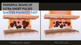 Pico Laser Pigmentation Treatment in Singapore  Sozo Aesthetic Clinic Dr Justin Boey [upl. by Alejna864]