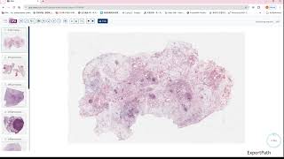 inflammatory myofibroblastic tumorIMT desmoid fibromatosis GIPATH [upl. by Nevyar]