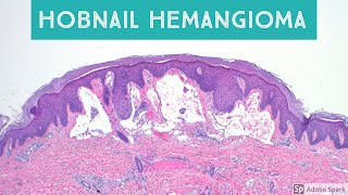 Hobnail Hemangioma Targetoid Hemosiderotic Hemangioma Retiform Hemangioendothelioma and Mimics [upl. by Nnyletak]