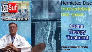 Disc Herniated  Intervertebral Disc Space Treatment  Ozone Injection  Dr Yousuf Memon Case8809 [upl. by Banebrudge78]