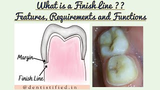 Finish lines in Fixed Partial Denture Finish Lines in Tooth preparation Functions and Requirements [upl. by Asillem]