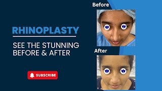 Rhinoplasty EXPERT Shares Patients JAWDROPPING Results [upl. by Ulland]