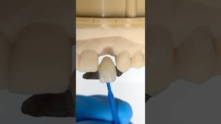 Lateral Maryland Bridge ​⁠EnvisiontecMain envisiontec lsk121shorts dentist teethsmile [upl. by Olpe]