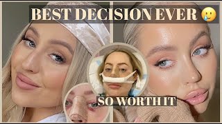 NOSE JOB VLOG My entire Rhinoplasty recovery  results the BEST Sydney surgeon [upl. by Pulchi372]