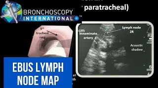 EBUS Lymph Node Map  Nodal Anatomy [upl. by Artina]