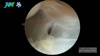 Arthroscopic Repair of Extensor Carpi Radialis Brevis in Patients With Tennis Elbow [upl. by Yenffit228]