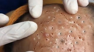 Treating Blackheads And Fatty Acne On Forehead At Sac Dep Spa [upl. by Akenehs]