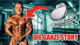 Herzstillstand Die Geschichte hinter dem Bodybuilder mit Herzschrittmacher [upl. by Abbotson]