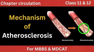 Steps of Atherosclerosis in urdu hindi  Pathogensis Explained for students  Ahterosclerosis [upl. by Nosraep12]