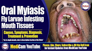 Oral Myiasis Infesting Mouth Tissues  Causes Symptoms Diagnosis and Treatment  Medicam YouTube [upl. by Isleana]