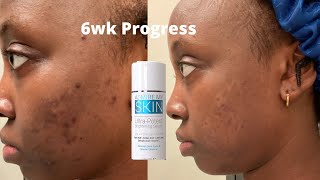 Remove dark spots with Holy Grail productadmire my skin [upl. by Airyt]