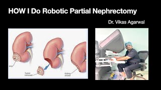 Robotic Partial nephrectomy for left lower pole kidney tumor [upl. by Wampler522]