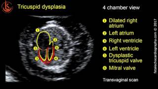 Fetal echocardiography at 1113 weeks Tricuspid Valve Dysplasia with Severe Tricuspid Regurgitation [upl. by Berne186]