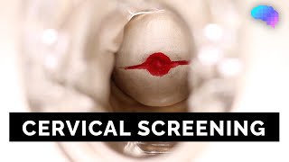 Cervical Screening SMEAR  OSCE Guide  UKMLA  CPSA [upl. by Octavian]